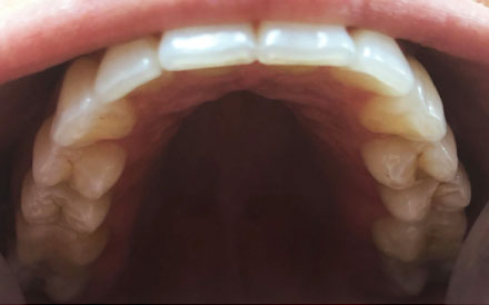 Top of Teeth
